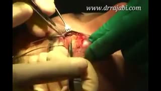 جراحی زیبایی پلک (بلفاروپلاستی)