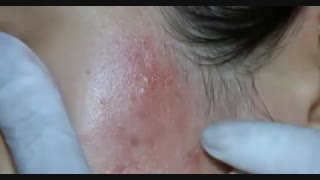 درماپن http://www.needling.ir