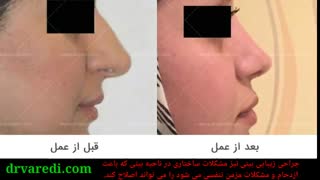 عمل زیبایی بینی گوشتی و استخوانی - دکتر پیام واردی
