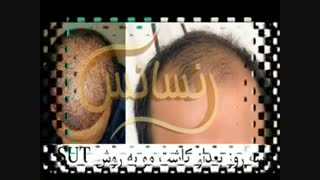 کاشت مو به روش SUT مرکز تخصصی موی رنسانس