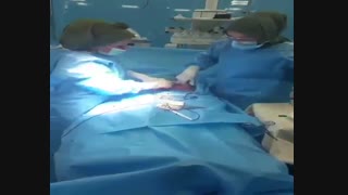 عمل سزارین دو قلویی