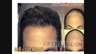 کاشت مو به روش SUT مرکز تخصصی موی رنسانس