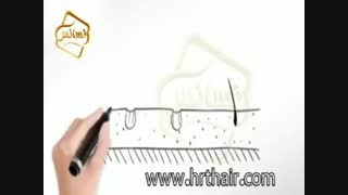 کاشت مو به روش SUT مرکز تخصصی موی رنسانس