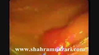 پولیپکتومی در روده بزرگ با کلونوسکوپ