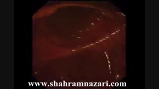 عبور از دریچه ایلیوسکال در طی یک کلونوسکوپی کامل