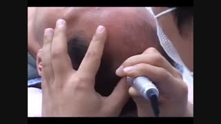 تقویت مو با میکرونیدلینگ http://www.needling.ir