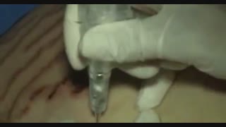 میکرونیدلینگ پریودنتیکس