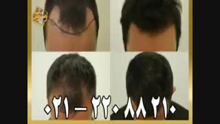 کاشت مو به روش SUT مرکز تخصصی موی رنسانس