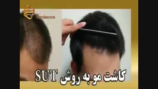 کاشت مو به روش SUT مرکز تخصصی موی رنسانس