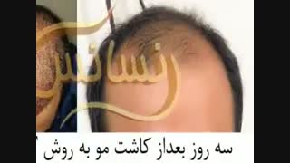 کاشت مو به روش SUT مرکز تخصصی موی رنسانس
