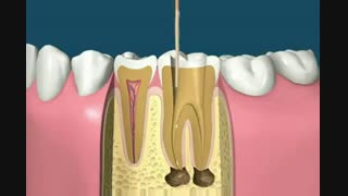 دندان و دیگر هیچ