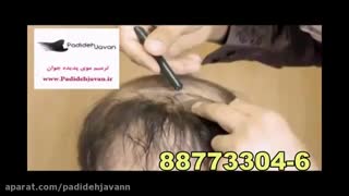 کاشت موی پدیده جوان