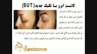کاشت ابرو طبیعی با روش SUT مرکز کاشت ابرو و مژه در ایران