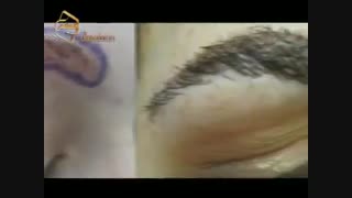 کاشت ابرو طبیعی با روش SUT مرکز کاشت ابرو و مژه در ایران
