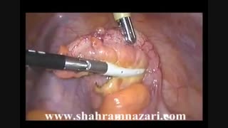 آپاندکتومی لاپاروسکوپیک(با استاپلر لاپاروسکوپی)در درمان آپاندیسیت حاد چرکی دندانپزشکی کودکان