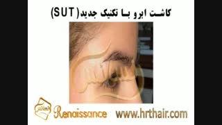کاشت ابرو طبیعی با روش SUT مرکز کاشت ابرو و مژه