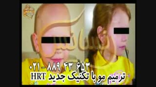 ترمیم مو به روش اختصاصی HRT مرکز تخصصی موی رنسانس