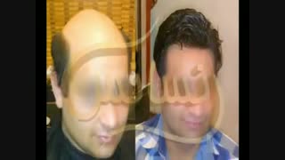 ترمیم مو به روش اختصاصی HRT مرکز تخصصی موی رنسانس