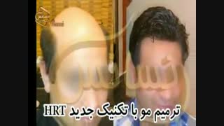ترمیم مو به روش اختصاصی HRT مرکز تخصصی موی رنسانس