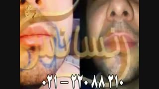 کاشت ریش و سبیل - کاشت مو و ترمیم مو رنسانس