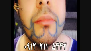 کاشت ریش و سبیل - کاشت مو و ترمیم مو رنسانس