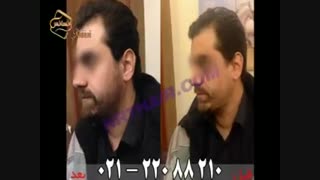 کاشت ریش و سبیل - کاشت مو و ترمیم مو رنسانس