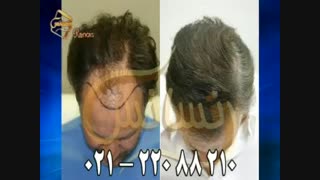 کاشت مو به روش موفق و جدید SUT مرکز تخصصی موی رنسانس