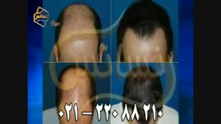 کاشت مو به روش موفق و جدید SUT مرکز تخصصی موی رنسانس
