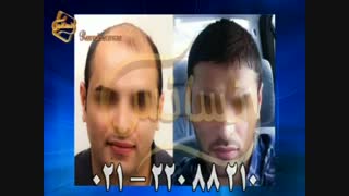 کاشت مو به روش موفق و جدید SUT مرکز تخصصی موی رنسانس