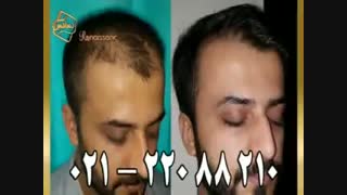 کاشت مو به روش موفق و جدید SUT مرکز تخصصی موی رنسانس
