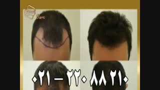 کاشت مو به روش موفق و جدید SUT مرکز تخصصی موی رنسانس