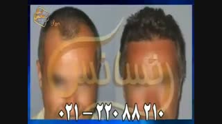 کاشت مو به روش موفق و جدید SUT مرکز تخصصی موی رنسانس