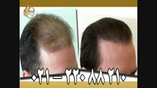 کاشت مو به روش موفق و جدید SUT مرکز تخصصی موی رنسانس