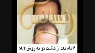 کاشت مو به روش موفق و جدید SUT مرکز تخصصی موی رنسانس