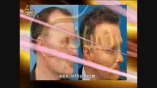 کاشت مو به روش موفق و جدید SUT مرکز تخصصی موی رنسانس