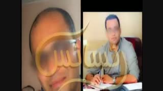 کاشت مو به روش موفق و جدید SUT مرکز تخصصی موی رنسانس