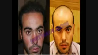 کاشت مو به روش موفق و جدید SUT مرکز تخصصی موی رنسانس