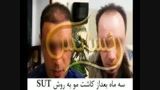 کاشت مو به روش موفق و جدید SUT مرکز تخصصی موی رنسانس