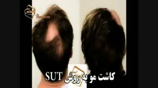کاشت مو به روش موفق و جدید SUT مرکز تخصصی موی رنسانس