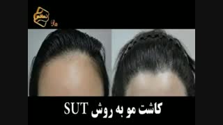 کاشت مو به روش موفق و جدید SUT مرکز تخصصی موی رنسانس