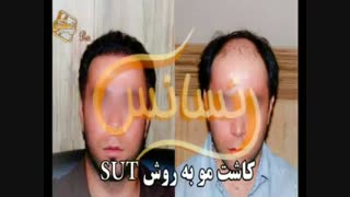 کاشت مو به روش موفق و جدید SUT مرکز تخصصی موی رنسانس