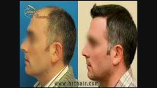 کاشت مو به روش موفق و جدید SUT مرکز تخصصی موی رنسانس