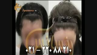 کاشت مو به روش موفق و جدید SUT مرکز تخصصی موی رنسانس