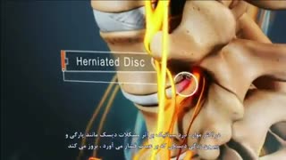 انیمیشن آموزشی جالب در مورد سیاتیک و دیسک کمر