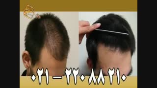 کاشت مو با دستگاه اتوماتیک SUT مرکز مو رنسانس