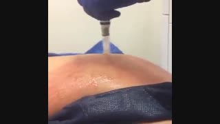 میکرونیدلینگ ترک شکم