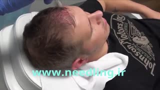 میکرونیدلینگ تقویت مو