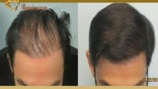 کاشت مو طبیعی با روش SUT مرکز کاشت و پیوند مو