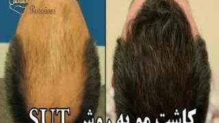 کاشت مو طبیعی با روش SUT مرکز کاشت و پیوند مو