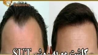 کاشت مو طبیعی با روش SUT مرکز کاشت و پیوند مو